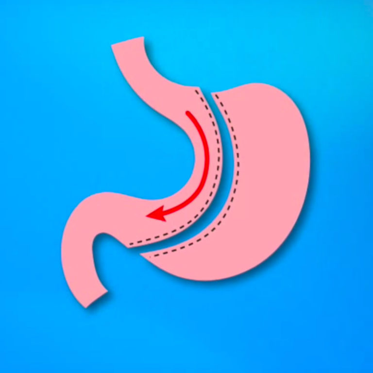 Another Name For Gastric Sleeve